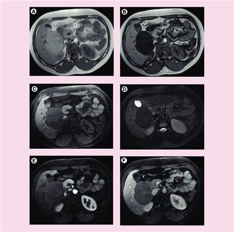 Imaging Features Of Hnf A Inactivated Hepatocellular Adenoma Large