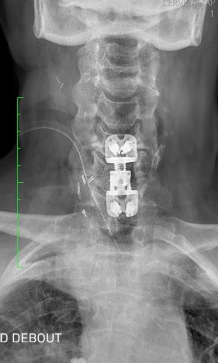 Neurochirurgie Lh Pital Priv Du Grand Narbonne R Alise Avec Succ S