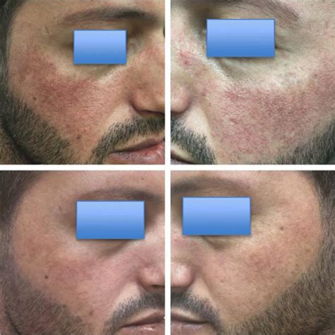 Improvement Of Etr Patient After The Fourth Session Download Scientific Diagram