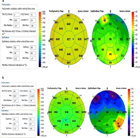 Evaluation Of Corneal Epithelial Thickness Mapping Using Anterior