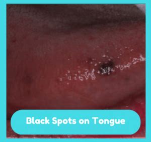 black-spots-on-tongue | Dentgap