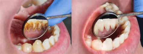 Dental Cleaning In Islamabad - Z Dental Studio - Cost and how it's done