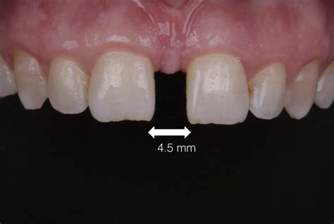 A Combined Approach For Diastema Closure Styleitaliano Org