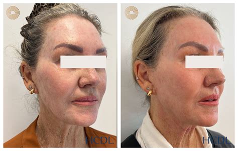 Resurfacing With Co Laser Hunter Coast Dermatology Laser