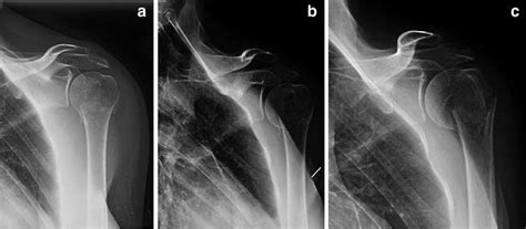 Complications of Treatment of Proximal Humerus Fractures ...