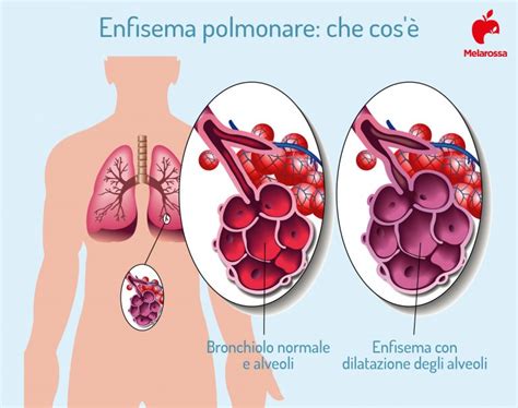 Enfisema polmonare cos è cause sintomi e cure Melarossa