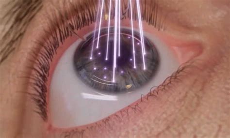 Lasik En Tunisie Chirurgie Des Yeux Au Laser Tarif Pas Cher