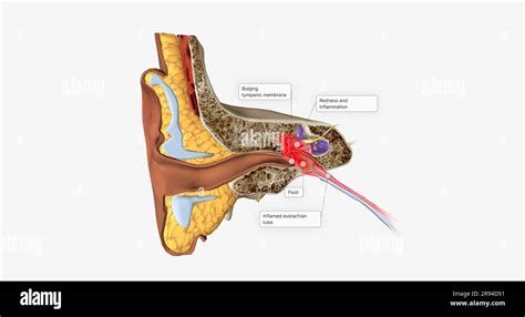 Acute Otitis Media Is An Infection And Inflammation Of The Middle Ear Usually With Fluid Behind