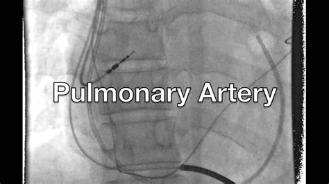 Right Heart Catheterization Pressures Heart Catheterization Cardiac Catheterization Heart