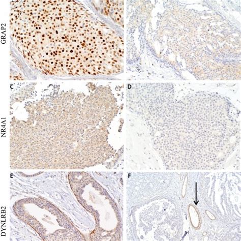 Representative Examples Of Aberrant Expression Of Three Candidate