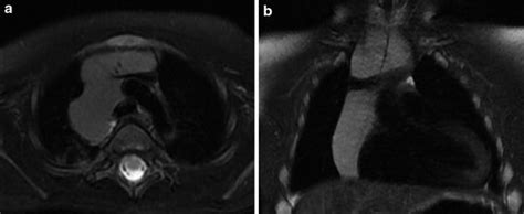 Of The Pediatric Thymus And Thymic Disorders Radiology Key