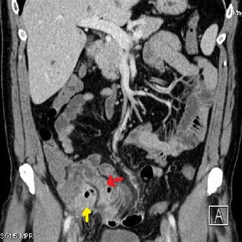 The Terminal Ileum With A Thickened And Contrast Enhancing Wall Red