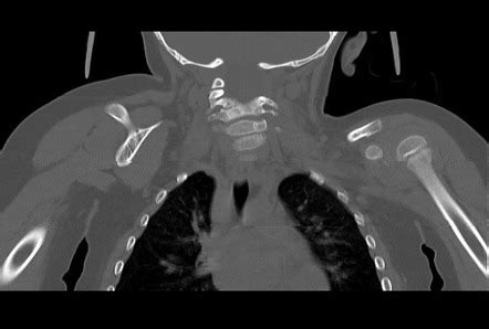 Klippel Feil syndrome - Sprengel deformity | Radiology Case ...