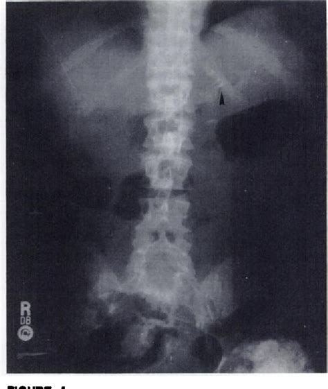 Figure From Periarticular Tumoral Calcinosis And Hypercalcemia In A