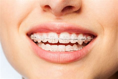 The Science Behind Braces Tony Weir Orthodontics