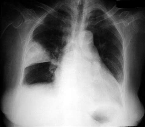 Wedge Shaped Peripheral Blunting Of Costophrenic Angle