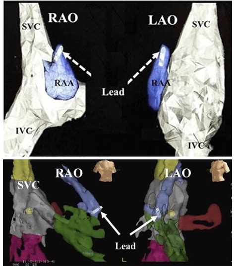 Pacemaker leads are located within the chambers of the heart [16 ...