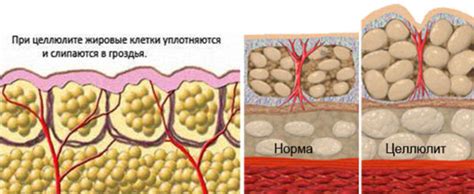 Самый легкий способ избавиться от целлюлита - Лайфхакер # ...