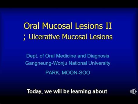 Oral Mucosal Lesion Ii Ulcerative Mucosal Lesion