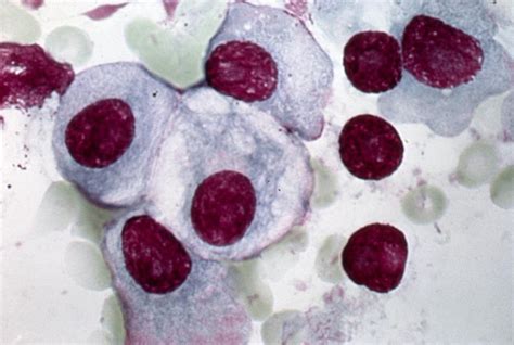 Multiple Myeloma Light Micrograph Photograph By Science Photo Library