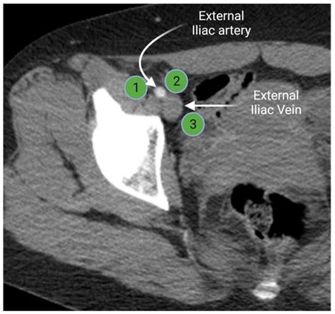 Cancers Free Full Text Oncologic Imaging Of The Lymphatic System Current Perspective With