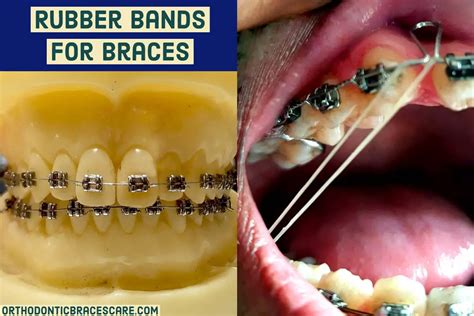 What Do Rubber Bands Do For Braces: Uses, Types, Colors | Orthodontic ...