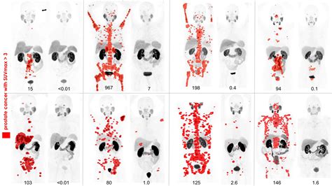 SNMMI Image Of The Year PSMA PET Imaging Of Theranostic For Advanced