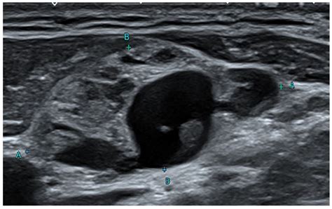 Thyroid Papillary Carcinoma Ultrasound