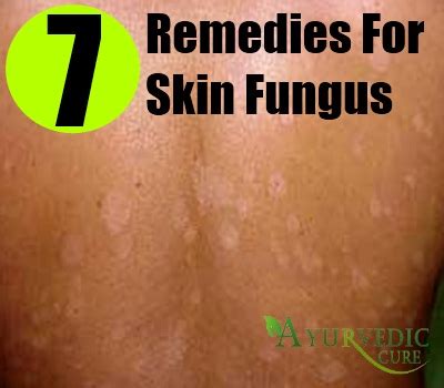 fungus on skin treatment - pictures, photos