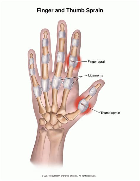 Thumb Sprain (Ulnar Collateral Ligament) | Singapore Orthopaedic Clinic