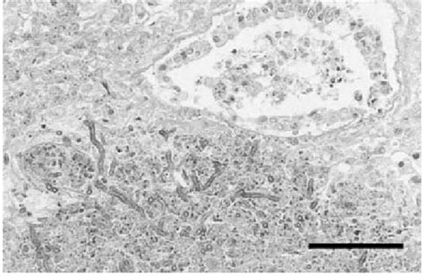 Histological Aspect Of A Diffuse Pneumonic Focus In Which Catarrhal Download Scientific Diagram