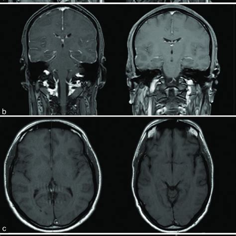 Comparison of MRI findings of spontaneous intracranial hypotension... | Download Scientific Diagram