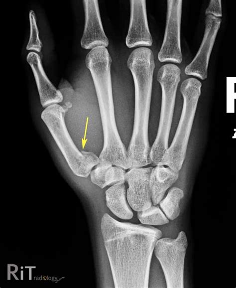 Metacarpal Bennetts Fracture A Fracture Of The Base Of The Thumb