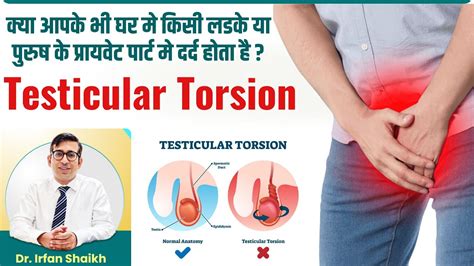 What Is Testicular Torsion In Hindi पुरुष के अंडकोष में दर्द Dr Irfan Shaikh Youtube