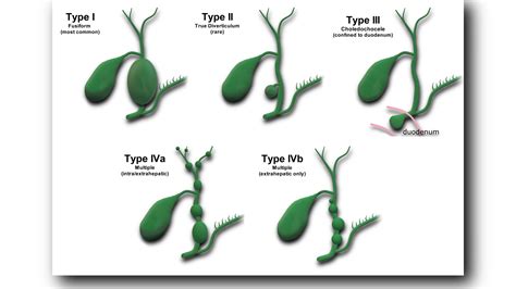 Choledochal Cyst – Sonographic Tendencies