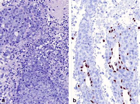 Smarca4 Deficient Thoracic Tumor Core Needle Biopsy Of A Mediastinal Download Scientific