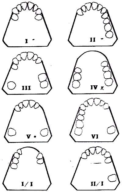 Stu-DENT Diaries: Removable Partial Denture Design