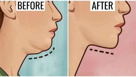 10 Tips On How To Get Rid Of Neck Fat