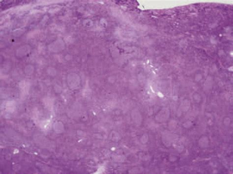 Extranodal Marginal Zone B Cell Lymphoma Of Mucosa Associated Lymphoid