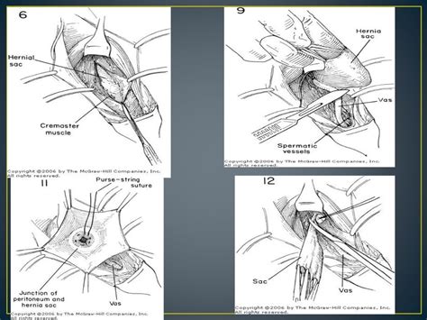 Inguinal Hernia Ppt