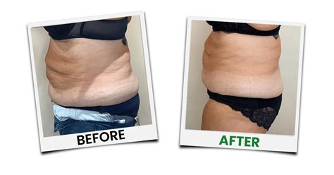 Cold Fat Removal Treatment Emerald Laser By Erchnoia