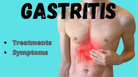 Gastritis Symptoms And Treatments Youtube