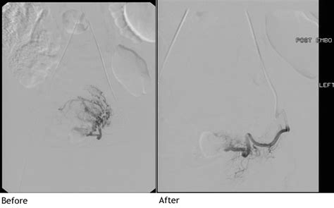 Uterine Fibroid Embolization X Ray Medical Sharp Grossmont Hospital