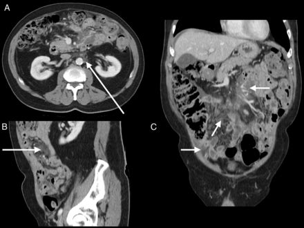 Peritoneal Lymphomatosis A Rare Presentation Of Follicular Lymphoma