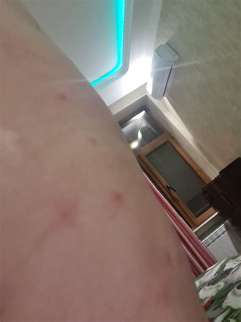 Красные пятно - Вопрос дерматологу - 03 Онлайн