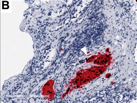 Immunohistochemistry Showing That The Cells Stain Positive For P40