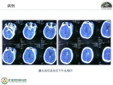 监测有道丨弥漫性轴索损伤并发脑室积血颅内压监测一例——颅脑创伤 神经重症周刊（第196期） 脑医汇 神外资讯 神介资讯