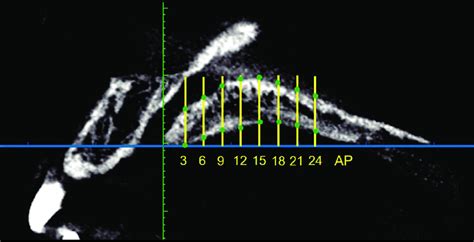 In Each Sagittal View The Palatal Bone Thickness Is Measured