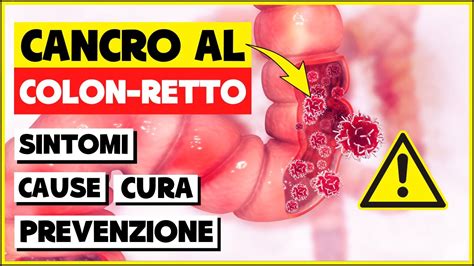 TUMORE AL COLON Sintomi Cause Cura E Prevenzione Quello Che Devi