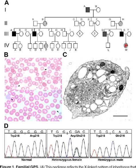 Figure 1 From X Linked Gray Platelet Syndrome Due To A Gata1 Arg216gln